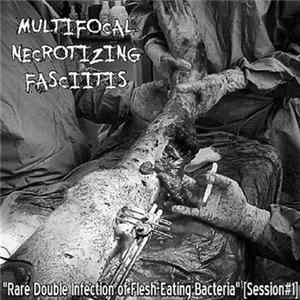 Multifocal Necrotizing Fasciitis - Rare Double Infection Of Flesh​-​Eating Bacteria FLAC